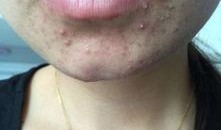 吃瓜吃的嘴角起痘